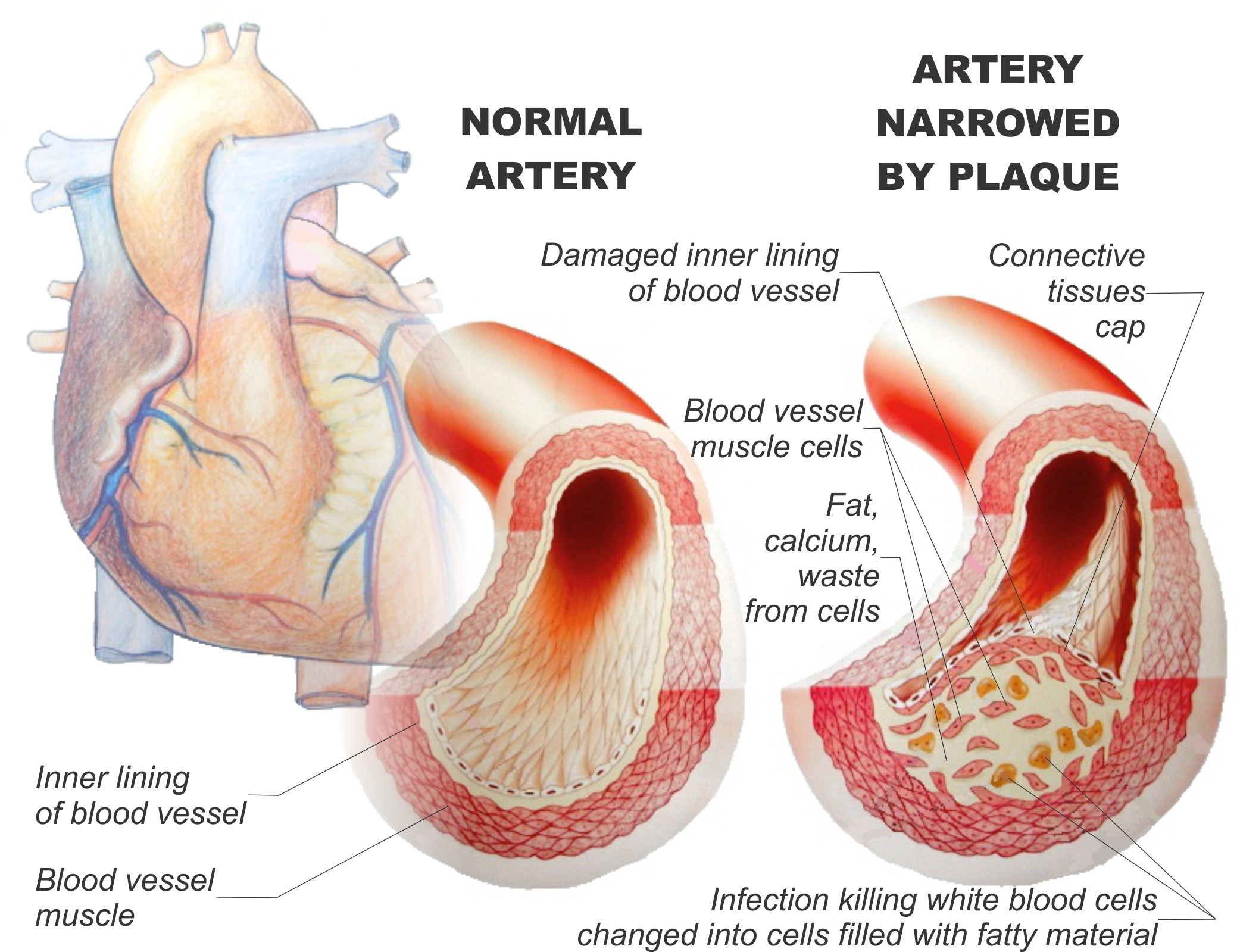 Normal artery and artery narrowed by plaque